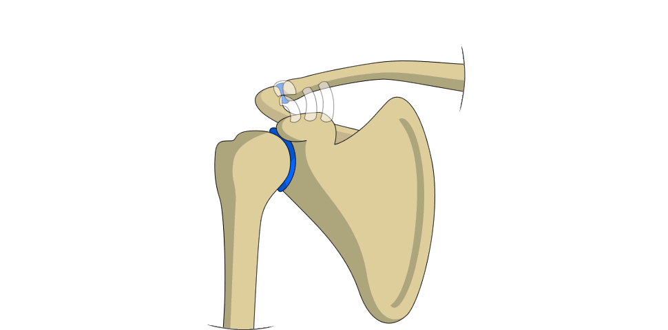 Acromioclavicular (AC) Joint Injury